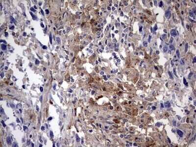 Immunohistochemistry: Galectin-3 Antibody (OTI1C7) - Azide and BSA Free [NBP2-71124] - Analysis of Adenocarcinoma of Human ovary tissue. (Heat-induced epitope retrieval by 1 mM EDTA in 10mM Tris, pH8.5, 120C for 3min)