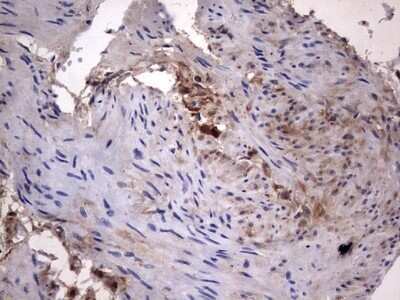 Immunohistochemistry: Galectin-3 Antibody (OTI1C7) - Azide and BSA Free [NBP2-71124] - Analysis of Carcinoma of Human kidney tissue. (Heat-induced epitope retrieval by 1 mM EDTA in 10mM Tris, pH8.5, 120C for 3min)