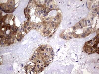 Immunohistochemistry: Galectin-3 Antibody (OTI1C7) - Azide and BSA Free [NBP2-71124] - Analysis of Carcinoma of Human liver tissue.(Heat-induced epitope retrieval by 1 mM EDTA in 10mM Tris, pH8.5, 120C for 3min)