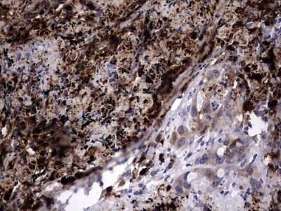 Immunohistochemistry: Galectin-3 Antibody (OTI1C7) - Azide and BSA Free [NBP2-71124] - Analysis of Carcinoma of Human lung tissue.(Heat-induced epitope retrieval by 1 mM EDTA in 10mM Tris, pH8.5, 120C for 3min)