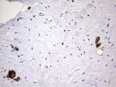 Immunohistochemistry: Galectin-3 Antibody (OTI1C7) - Azide and BSA Free [NBP2-71124] - Analysis of Carcinoma of Human pancreas tissue. (Heat-induced epitope retrieval by 1 mM EDTA in 10mM Tris, pH8.5, 120C for 3min)