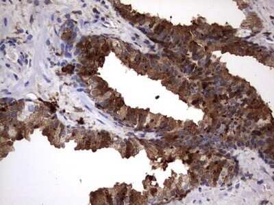 Immunohistochemistry: Galectin-3 Antibody (OTI1C7) - Azide and BSA Free [NBP2-71124] - Analysis of Carcinoma of Human prostate tissue. (Heat-induced epitope retrieval by 1 mM EDTA in 10mM Tris, pH8.5, 120C for 3min)