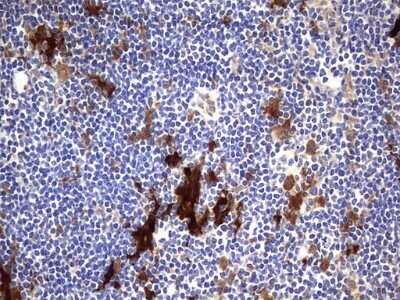 Immunohistochemistry: Galectin-3 Antibody (OTI1C7) - Azide and BSA Free [NBP2-71124] - Analysis of Human lymphoma tissue. (Heat-induced epitope retrieval by 1 mM EDTA in 10mM Tris, pH8.5, 120C for 3min)