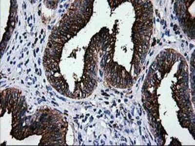 Immunohistochemistry: Galectin-3BP/MAC-2BP/LGALS3BP Antibody (OTI6B7) - Azide and BSA Free [NBP2-71125] - Staining of paraffin-embedded Adenocarcinoma of Human endometrium tissue using anti-LGALS3BP mouse monoclonal antibody.