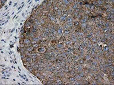 Immunohistochemistry: Galectin-3BP/MAC-2BP/LGALS3BP Antibody (OTI6B7) - Azide and BSA Free [NBP2-71125] - Staining of paraffin-embedded Carcinoma of Human bladder tissue using anti-LGALS3BP mouse monoclonal antibody.