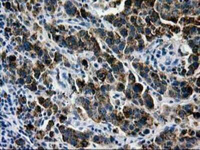 Immunohistochemistry: Galectin-3BP/MAC-2BP/LGALS3BP Antibody (OTI6B7) - Azide and BSA Free [NBP2-71125] - Staining of paraffin-embedded Carcinoma of Human lung tissue using anti-LGALS3BP mouse monoclonal antibody.