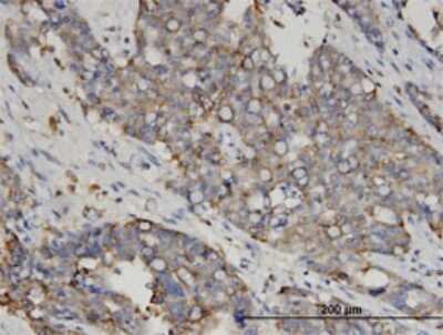 Immunohistochemistry-Paraffin: Galectin-4 Antibody (1E8) [H00003960-M01] - Analysis of monoclonal antibody to LGALS4 on formalin-fixed paraffin-embedded human ovarian cancer. Antibody concentration 3 ug/ml.
