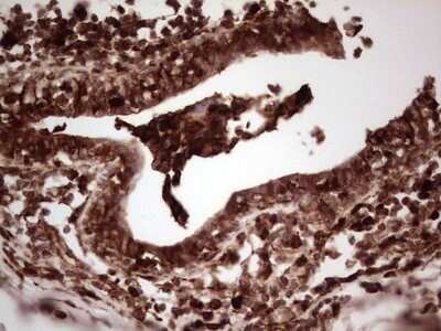 Immunohistochemistry: Galectin-9 Antibody (OTI1D12) - Azide and BSA Free [NBP2-71132] - Analysis of Adenocarcinoma of Human breast tissue. (Heat-induced epitope retrieval by 1 mM EDTA in 10mM Tris, pH8.5, 120C for 3min)