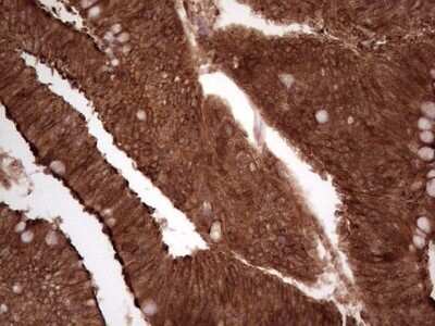 Immunohistochemistry: Galectin-9 Antibody (OTI1D12) - Azide and BSA Free [NBP2-71132] - Analysis of Adenocarcinoma of Human colon tissue. (Heat-induced epitope retrieval by 1 mM EDTA in 10mM Tris, pH8.5, 120C for 3min)