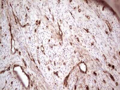 Immunohistochemistry: Galectin-9 Antibody (OTI1D12) - Azide and BSA Free [NBP2-71132] - Analysis of Adenocarcinoma of Human endometrium tissue. (Heat-induced epitope retrieval by 1 mM EDTA in 10mM Tris, pH8.5, 120C for 3min)