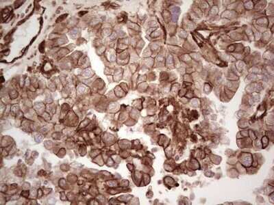 Immunohistochemistry: Galectin-9 Antibody (OTI1D12) - Azide and BSA Free [NBP2-71132] - Analysis of Adenocarcinoma of Human ovary tissue. (Heat-induced epitope retrieval by 1 mM EDTA in 10mM Tris, pH8.5, 120C for 3min)