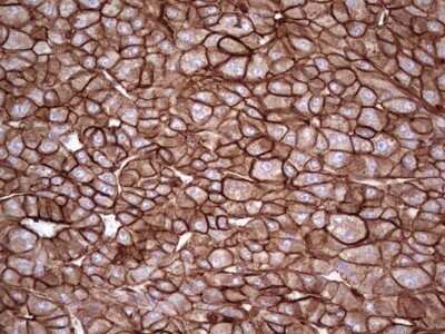 Immunohistochemistry: Galectin-9 Antibody (OTI1D12) - Azide and BSA Free [NBP2-71132] - Analysis of Carcinoma of Human liver tissue. (Heat-induced epitope retrieval by 1 mM EDTA in 10mM Tris, pH8.5, 120C for 3min)