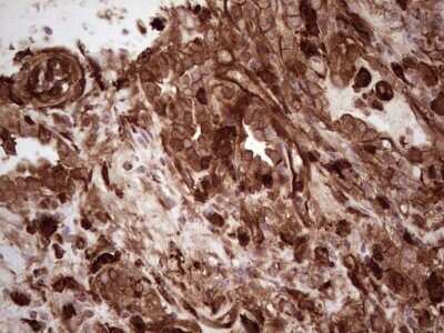 Immunohistochemistry: Galectin-9 Antibody (OTI1D12) - Azide and BSA Free [NBP2-71132] - Analysis of Carcinoma of Human lung tissue. (Heat-induced epitope retrieval by 1 mM EDTA in 10mM Tris, pH8.5, 120C for 3min)