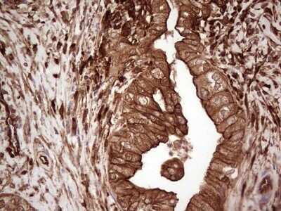 Immunohistochemistry: Galectin-9 Antibody (OTI1D12) - Azide and BSA Free [NBP2-71132] - Analysis of Carcinoma of Human pancreas. (Heat-induced epitope retrieval by 1 mM EDTA in 10mM Tris, pH8.5, 120C for 3min)