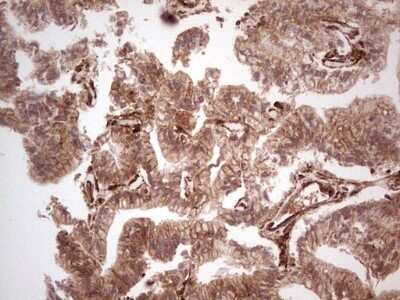 Immunohistochemistry: Galectin-9 Antibody (OTI1D12) - Azide and BSA Free [NBP2-71132] - Analysis of Carcinoma of Human prostate tissue. (Heat-induced epitope retrieval by 1 mM EDTA in 10mM Tris, pH8.5, 120C for 3min)