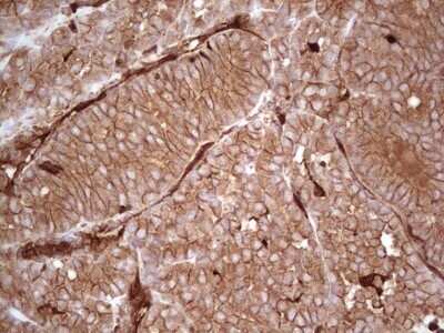 Immunohistochemistry: Galectin-9 Antibody (OTI1D12) - Azide and BSA Free [NBP2-71132] - Analysis of Carcinoma of Human thyroid tissue. (Heat-induced epitope retrieval by 1 mM EDTA in 10mM Tris, pH8.5, 120C for 3min)