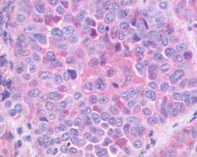 Immunohistochemistry-Paraffin: Gastrin-releasing Peptide R/GRPR Antibody [NLS830] - Gastrin-releasing Peptide/Bombesin/Neuromedin C Antibody [NLS830] - Analysis of anti-GRPR antibody with human lung, non-small cell carcinoma.