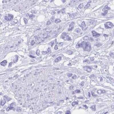 Immunohistochemistry: Gastrokine 2 Antibody [NBP2-31688] - Staining of stomach cancer.