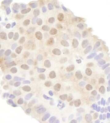 <b>Independent Antibodies Validation. </b>Immunohistochemistry: Gemin 3 Antibody [NB100-1801] - Sample: FFPE section of human breast carcinoma. Antibody: Affinity purified rabbit anti-DDX20 used at a dilution of 1:200 ( 1ug/ml). Detection: DAB