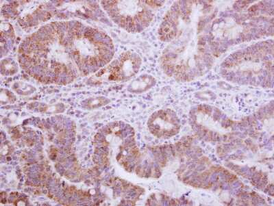 Immunohistochemistry-Paraffin: Gemin 3 Antibody [NBP2-16638] - Immunohistochemical analysis of paraffin-embedded Colon ca, using antibody at 1:250 dilution.