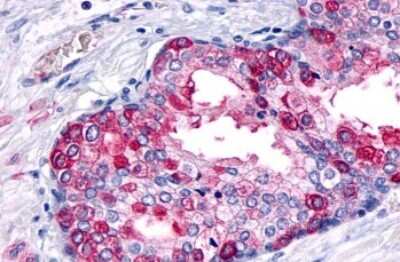 Immunohistochemistry-Paraffin: Glucagon R/GCGR Antibody [NLS4257] - Human Prostate, Carcinoma tissue after heat-induced antigen retrieval.