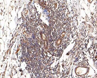 Immunohistochemistry-Paraffin: Glucocorticoid Receptor alpha Antibody (3F2) [NBP2-75509] - Analysis of paraffin-embedded human breast carcinoma tissue with Mouse anti-Glucocorticoid Receptor alpha antibody at 1/200 dilution. The section was pre-treated using heat mediated antigen retrieval with sodium citrate buffer (pH 6.0) for 2 minutes. The tissues were blocked in 1% BSA for 20 minutes at room temperature, washed with ddH2O and PBS, and then probed with the primary antibody at 1/200 dilution for 1 hour at room temperature. The detection was performed using an HRP conjugated compact polymer system. DAB was used as the chromogen. Tissues were counterstained with hematoxylin and mounted with DPX.