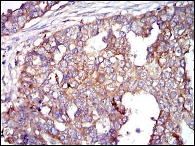 Immunohistochemistry-Paraffin: Glucose 6 Phosphate Dehydrogenase Antibody (2H7) - Azide and BSA Free [NBP2-80752] - Analysis of paraffin-embedded breast cancer tissues using Glucose 6 Phosphate Dehydrogenase mouse mAb with DAB staining. Image from the standard format of this antibody.