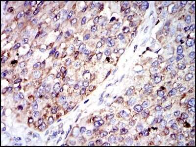 Immunohistochemistry-Paraffin: Glucose 6 Phosphate Dehydrogenase Antibody (2H7) - Azide and BSA Free [NBP2-80752] - Analysis of paraffin-embedded kidney cancer tissues using Glucose 6 Phosphate Dehydrogenase mouse mAb with DAB staining. Image from the standard format of this antibody.