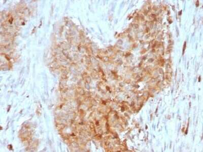 Immunohistochemistry-Paraffin: Glucose 6 phosphate isomerase Antibody (CPTC-GPI-1) - Azide and BSA Free [NBP2-79845] - Formalin-fixed, paraffin-embedded human Breast Carcinoma stained with Glucose 6 phosphate isomerase Antibody (CPTC-GPI-1).