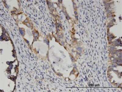 Immunohistochemistry-Paraffin: Glutamate Dehydrogenase 2/GLUD2 Antibody (3C2) [H00002747-M01] - Analysis of monoclonal antibody to GLUD2 on formalin-fixed paraffin-embedded human ovarian cancer. Antibody concentration 1 ug/ml.