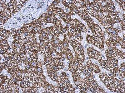 Immunohistochemistry-Paraffin: Glutamate Dehydrogenase 2/GLUD2 Antibody [NBP2-16678] - Analysis of paraffin-embedded Hepatoma, using antibody at 1:500 dilution.