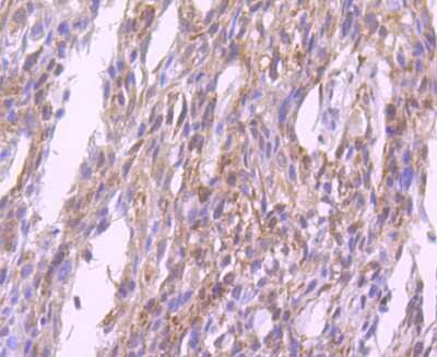 Immunohistochemistry-Paraffin: Glutathione Peroxidase 1/GPX1 Antibody (JF0944) [NBP2-66874] - Analysis of paraffin-embedded human breast carcinoma tissue using anti-Glutathione Peroxidase 1 antibody. Counter stained with hematoxylin.