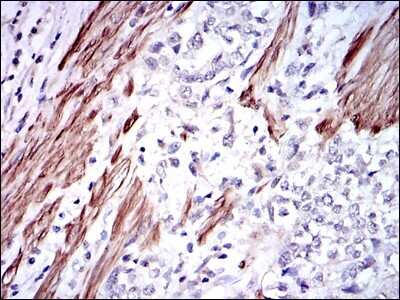 Immunohistochemistry-Paraffin: Glutathione S-Transferase mu 1/GSTM1 Antibody (1H4A4) [NBP2-22185] - Immunohistochemical analysis of paraffin-embedded rectum cancer tissues using GSTM1 mouse mAb with DAB staining.