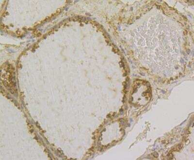 Immunohistochemistry: Glutathione S-Transferase pi 1/GSTP1 Antibody (11D5) [NBP2-76868] - Immunohistochemical analysis of paraffin-embedded human thyroid gland tissue using anti-GST3 antibody. The section was pre-treated using heat mediated antigen retrieval with Tris-EDTA buffer (pH 8.0-8.4) for 20 minutes.The tissues were blocked in 5% BSA for 30 minutes at room temperature, washed with ddH2O and PBS, and then probed with the antibody at 1/200 dilution, for 30 minutes at room temperature and detected using an HRP conjugated compact polymer system. DAB was used as the chrogen. Counter stained with hematoxylin and mounted with DPX.