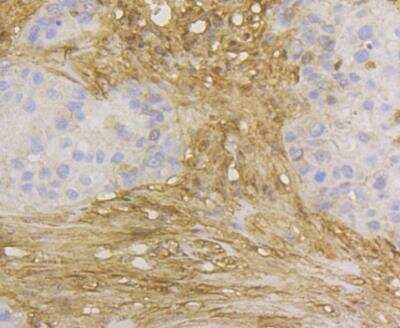 Immunohistochemistry: Glutathione S-Transferase pi 1/GSTP1 Antibody (11D5) [NBP2-76868] - Immunohistochemical analysis of paraffin-embedded human breast cancer tissue using anti-GST3 antibody. The section was pre-treated using heat mediated antigen retrieval with Tris-EDTA buffer (pH 8.0-8.4) for 20 minutes.The tissues were blocked in 5% BSA for 30 minutes at room temperature, washed with ddH2O and PBS, and then probed with the antibody at 1/200 dilution, for 30 minutes at room temperature and detected using an HRP conjugated compact polymer system. DAB was used as the chrogen. Counter stained with hematoxylin and mounted with DPX.