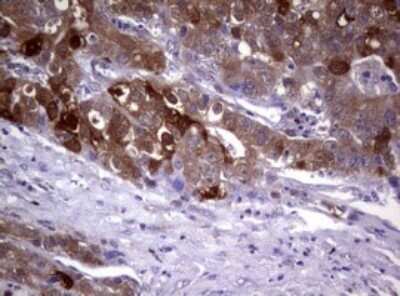 Immunohistochemistry: Glutathione S-Transferase pi 1/GSTP1 Antibody (OTI4B6) - Azide and BSA Free [NBP2-70857] - Analysis of Adenocarcinoma of Human colon tissue. (Heat-induced epitope retrieval by 10mM citric buffer, pH6.0, 120C for 3min)