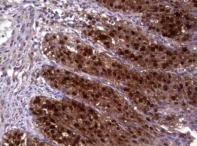 Immunohistochemistry: Glutathione S-Transferase pi 1/GSTP1 Antibody (OTI4B6) - Azide and BSA Free [NBP2-70857] - Analysis of Adenocarcinoma of Human ovary tissue. (Heat-induced epitope retrieval by 10mM citric buffer, pH6.0, 120C for 3min)