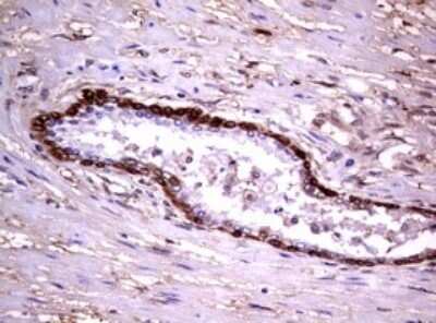 Immunohistochemistry: Glutathione S-Transferase pi 1/GSTP1 Antibody (OTI4B6) - Azide and BSA Free [NBP2-70857] - Analysis of Carcinoma of Human prostate tissue. (Heat-induced epitope retrieval by 10mM citric buffer, pH6.0, 120C for 3min)