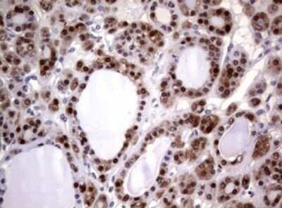 Immunohistochemistry: Glutathione S-Transferase pi 1/GSTP1 Antibody (OTI4B6) - Azide and BSA Free [NBP2-70857] - Analysis of Carcinoma of Human thyroid tissue. (Heat-induced epitope retrieval by 10mM citric buffer, pH6.0, 120C for 3min)