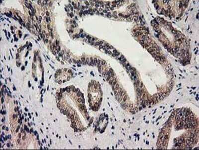 Immunohistochemistry: Glutathione Synthetase Antibody (OTI1B8) - Azide and BSA Free [NBP2-70854] - Staining of paraffin-embedded Carcinoma of Human prostate tissue using anti-Glutathione Synthetase mouse monoclonal antibody.