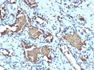 Immunohistochemistry-Paraffin: Glycophorin A Antibody (GYPA/1725R) - Azide and BSA Free [NBP2-54470] - Formalin-fixed, paraffin-embedded human Angiosarcoma stained with Recombinant Rabbit Monoclonal Antibody (GYPA/1725R)