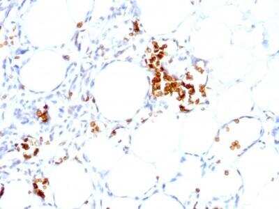 Immunohistochemistry-Paraffin: Glycophorin A Antibody (GYPA/280) - Azide and BSA Free [NBP2-47718] - Formalin-fixed, paraffin-embedded human Angiosarcoma stained with Glycophorin A Antibody (GYPA/280).