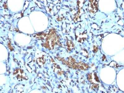 Immunohistochemistry-Paraffin: Glycophorin A Antibody (GYPA/280) - IHC-Prediluted [NBP2-48382] - Formalin-fixed, paraffin-embedded human Angiosarcoma stained with Glycophorin A Mouse Monoclonal Antibody (GYPA/280).