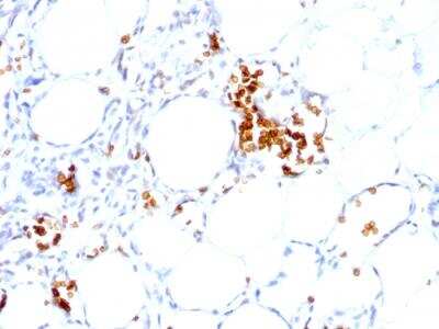 Immunohistochemistry-Paraffin: Glycophorin A Antibody (GYPA/280) - IHC-Prediluted [NBP2-48382] - Formalin-fixed, paraffin-embedded human Angiosarcoma stained with Glycophorin A Mouse Monoclonal Antibody (GYPA/280).