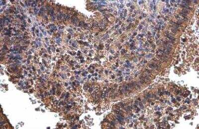 Immunohistochemistry-Paraffin: Glyoxalase I Antibody (266) [NBP2-43618] - Glyoxalase I Antibody (266) detects Glyoxalase I protein at cytoplasm by immunohistochemical analysis. Sample: Paraffin-embedded human ovarian cancer.Glyoxalase I stained by Glyoxalase I Antibody (266) diluted at 1:200.