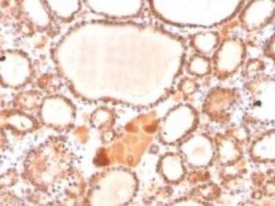 Immunohistochemistry-Paraffin: Glyoxalase I Antibody (CPTC-GLO1-1) [NBP3-07311] - Formalin-fixed, paraffin-embedded human thyroid carcinoma stained with Glyoxalase I Mouse Monoclonal Antibody (CPTC-GLO1-1).