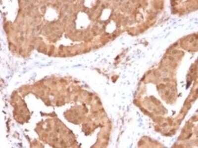 Immunohistochemistry-Paraffin: Glyoxalase I Antibody (CPTC-GLO1-1) [NBP3-07311] - Formalin-fixed, paraffin-embedded human prostate carcinoma stained with Glyoxalase I Mouse Monoclonal Antibody (CPTC-GLO1-1).