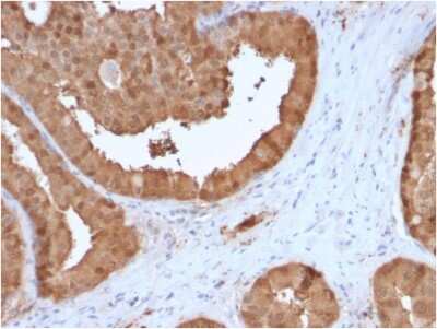 Immunohistochemistry-Paraffin: Glyoxalase I Antibody (CPTC-GLO1-3) - Azide and BSA Free [NBP3-08556] - Formalin-fixed, paraffin-embedded human prostate carcinoma stained with Glyoxalase I Mouse Monoclonal Antibody (CPTC-GLO1-3).