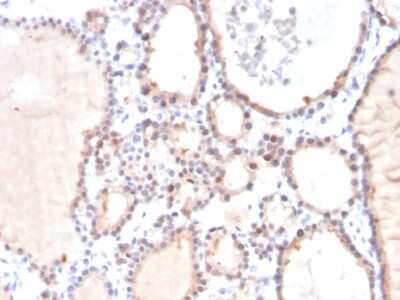 Immunohistochemistry-Paraffin: Glyoxalase I Antibody (CPTC-GLO1-3) - Azide and BSA Free [NBP3-08556] - Formalin-fixed, paraffin-embedded human thyroid carcinoma stained with Glyoxalase I Mouse Monoclonal Antibody (CPTC-GLO1-3).
