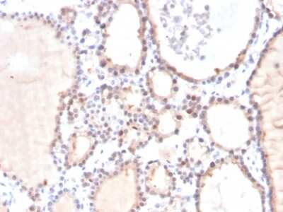 Immunohistochemistry-Paraffin: Glyoxalase I Antibody (CPTC-GLO1-3) [NBP3-07312] - Formalin-fixed, paraffin-embedded human thyroid carcinoma stained with Glyoxalase I Mouse Monoclonal Antibody (CPTC-GLO1-3).